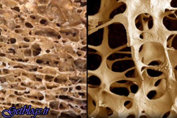 تشخیص زودهنگام بیماری پوکی استخوان از روی تراشه‌های ناخن