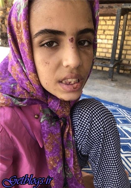 عکس) + از شکستن دندان با چکش تا بستن لب‌های دختر فرزند ۱۲ ساله با چسب حراراتی (