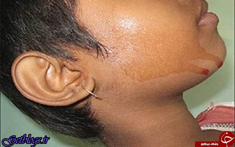 عکس ، دختری که خون عرق می کند!