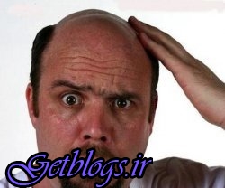 ریزش روزانه ۵۰ تا ۱۰۰ تار مو طبیعی است