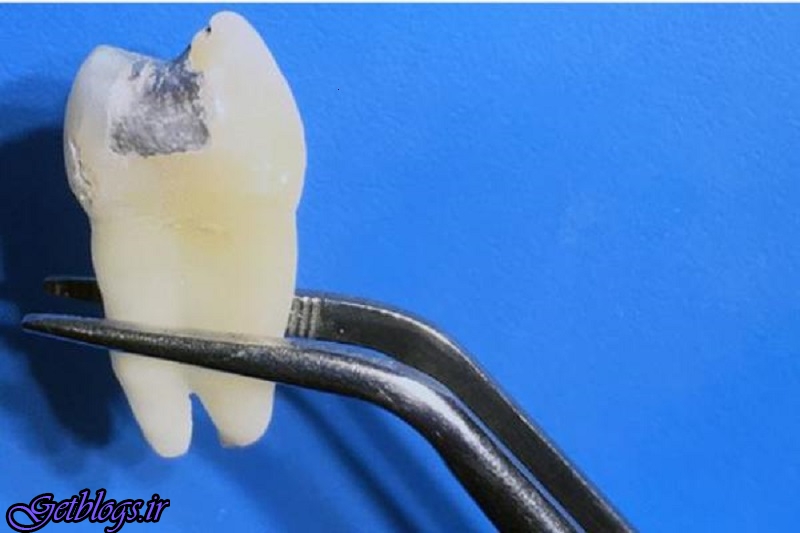 نشت جیوه از دندان های پرشده در اثر تصویربرداری ام آر آی