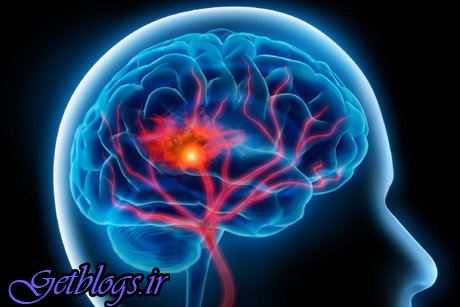 عکس های سکته مغزی قابل درمان است؟ سکته مغزی قابل درمان است؟